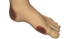 Image of a foot wound