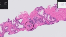 Paige Prostate software identifying a suspicious area in a biopsy slide