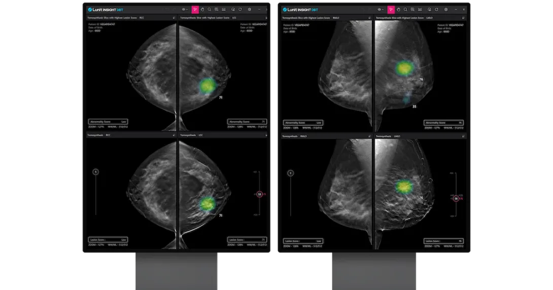 An analysis report generated by the Lunit INSIGHT DBT